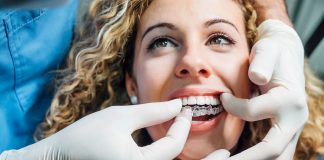 Doktor mit weißen Handschuhen setzt einer Frau eine Invisalign Schiene ein.